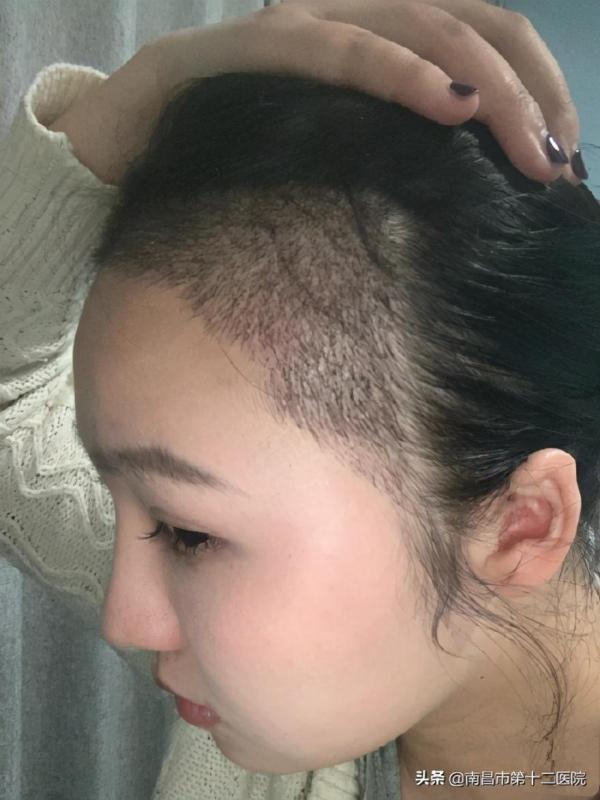 小姐姐分享自己的植發(fā)經(jīng)歷,不得不說真的加分不少